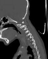 Butterfly vertebra (Radiopaedia 77903-90209 Sagittal bone window 22).jpg