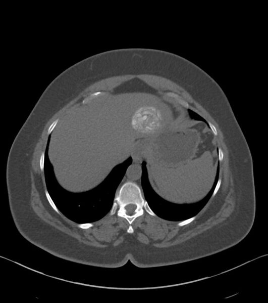 File:Calcified hepatic hydatid cyst (Radiopaedia 81127-94738 Axial non-contrast 15).jpg