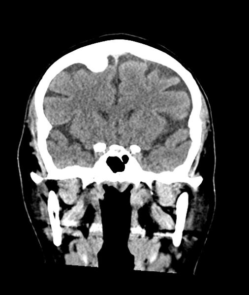 File:Calcified meningioma (Radiopaedia 74361-85243 Coronal non-contrast 19).jpg