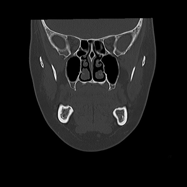 File:Canal up mastoidectomy (Radiopaedia 78108-90638 Coronal bone window 13).jpg