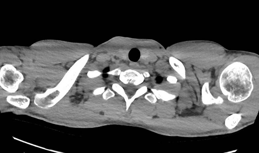 Cannabis-induced diffuse alveolar hemorrhage (Radiopaedia 89834-106946 Axial non-contrast 2).jpg