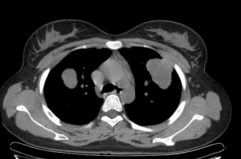 File:Cannonball metastases - uterine choriocarcinoma (Radiopaedia 70137-80173 Axial non-contrast 31).jpg