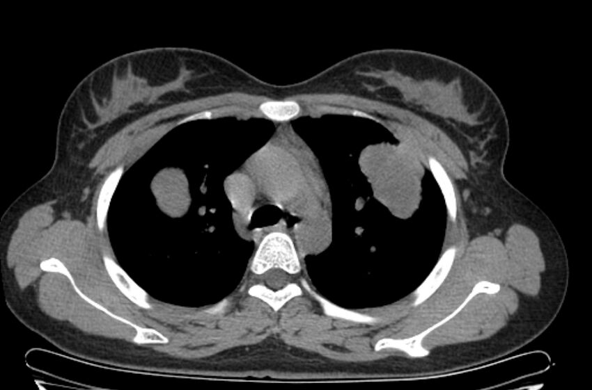 Cannonball metastases - uterine choriocarcinoma (Radiopaedia 70137-80173 Axial non-contrast 31).jpg