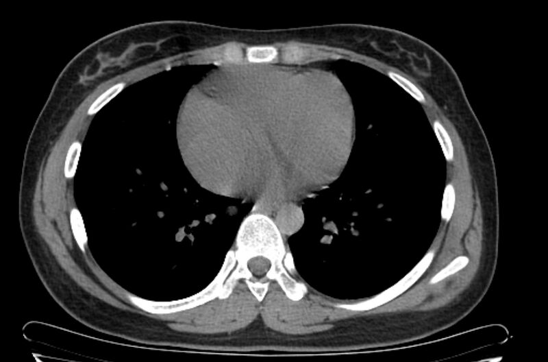 File:Cannonball metastases - uterine choriocarcinoma (Radiopaedia 70137-80173 Axial non-contrast 78).jpg