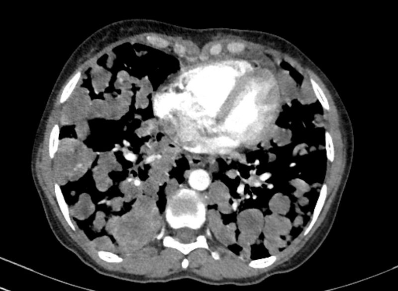 File:Cannonball metastases from breast cancer (Radiopaedia 91024-108569 A 83).jpg
