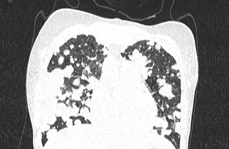 File:Cannonball metastases from breast cancer (Radiopaedia 91024-108569 Coronal lung window 44).jpg