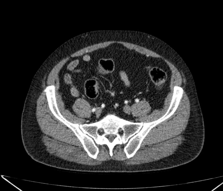 Carcinoid tumor with hepatic metastases (Radiopaedia 22651-22670 B 74).jpg