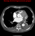 Cardiac perforation following transcatheter aortic valve implantation (Radiopaedia 23714-23863 A 5).png