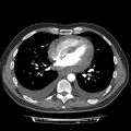 Cardiac tamponade (Radiopaedia 78607-91368 Axial C+ CTPA 55).jpg