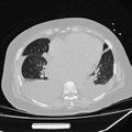 Cardiogenic pulmonary edema (Radiopaedia 29213-29609 Axial lung window 64).jpg