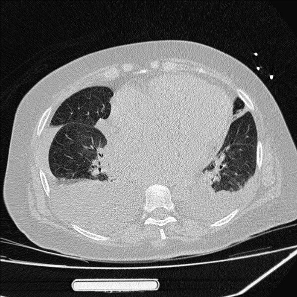 File:Cardiogenic pulmonary edema (Radiopaedia 29213-29609 Axial lung window 64).jpg