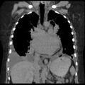 Cardiogenic pulmonary edema (Radiopaedia 29213-29609 Coronal non-contrast 21).jpg
