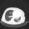 Carotid body tumor (Radiopaedia 21021-20948 Axial lung window 25).jpg