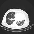 Carotid body tumor (Radiopaedia 21021-20948 Axial lung window 26).jpg