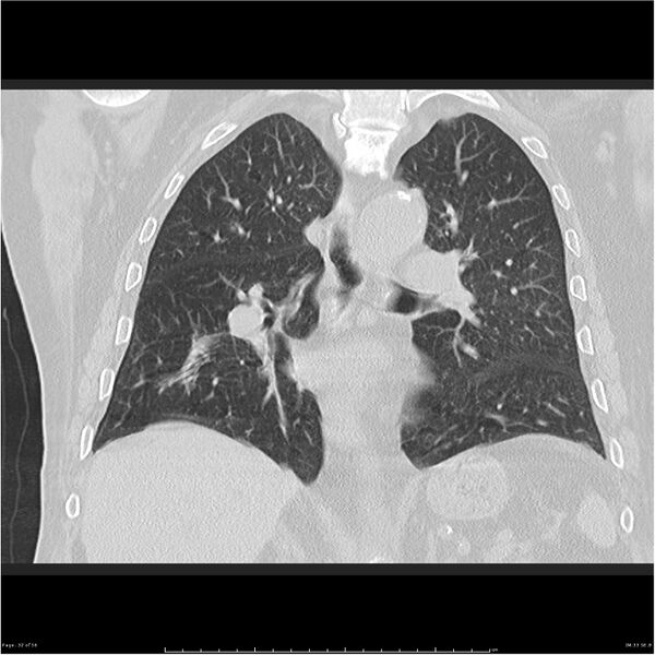 File:Cavitating left lower lobe lesion - squamous cell lung cancer (Radiopaedia 27749-28176 Coronal lung window 32).jpg