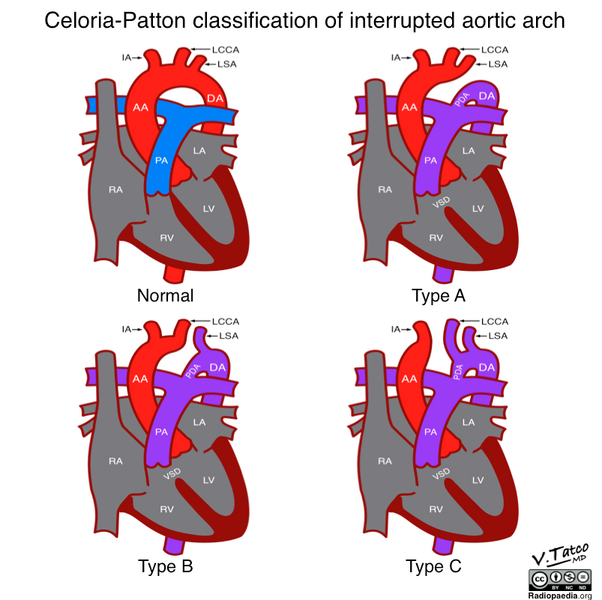 File:Celoria-Patton classification of interrupted aortic arch (illustration) (Radiopaedia 51881-57708 A 1).png