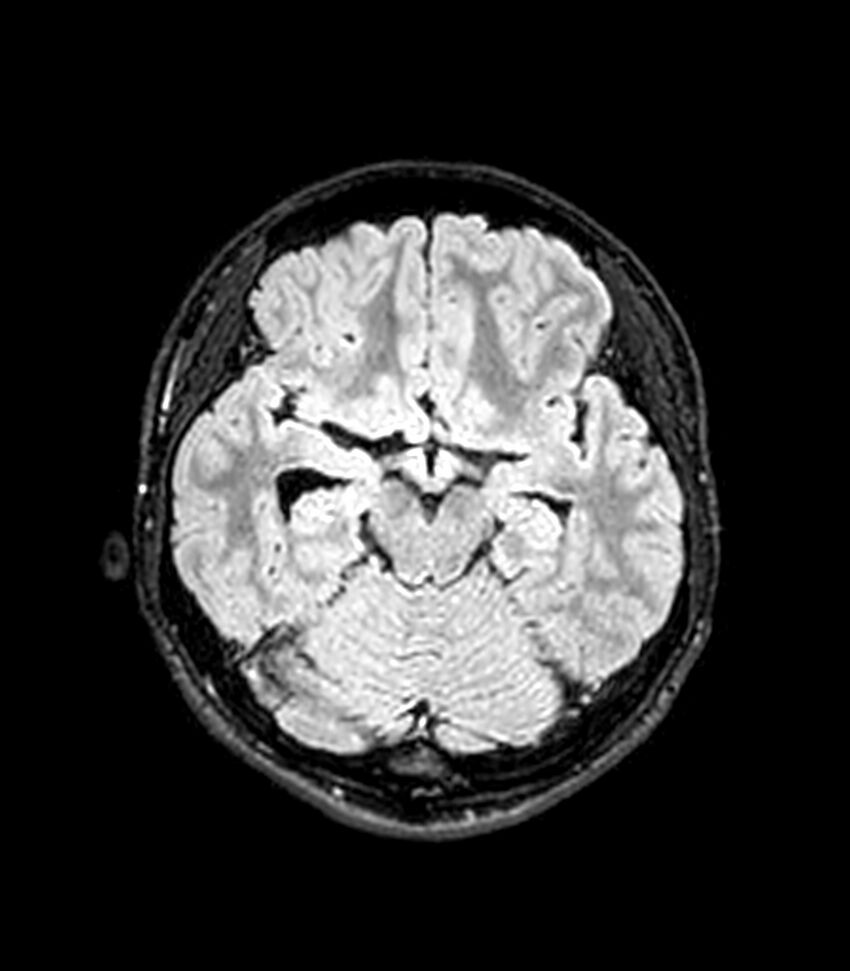 Central neurocytoma (Radiopaedia 79320-92380 Axial FLAIR 194).jpg