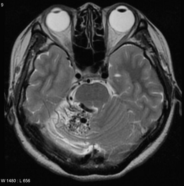 File:Cerebellar arteriovenous malformation (Radiopaedia 5220-6988 Axial T2 5).jpg
