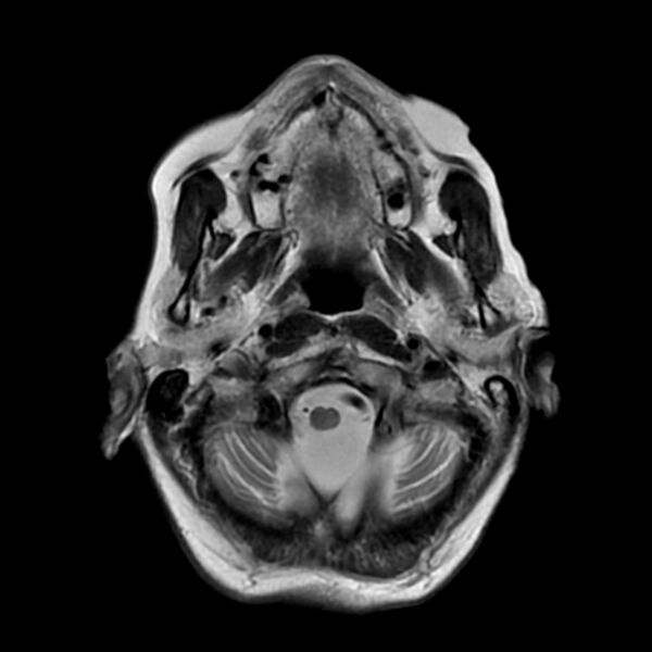 File:Cerebellar ataxia with neuropathy and vestibular areflexia syndrome (CANVAS) (Radiopaedia 74283-85159 Axial T2 3).jpg