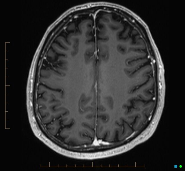 File:Cerebellar gangliocytoma (Radiopaedia 65377-74422 Axial T1 C+ 98).jpg
