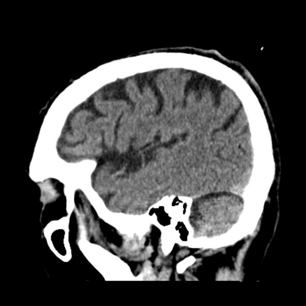 File:Cerebellar hemorrhage (Radiopaedia 27193-27359 C 10).jpg