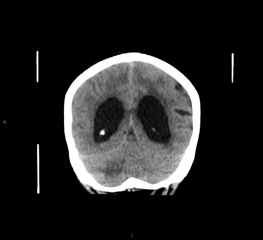 Cerebellar hemorrhage (Radiopaedia 58793-66027 Coronal non-contrast 23).jpg
