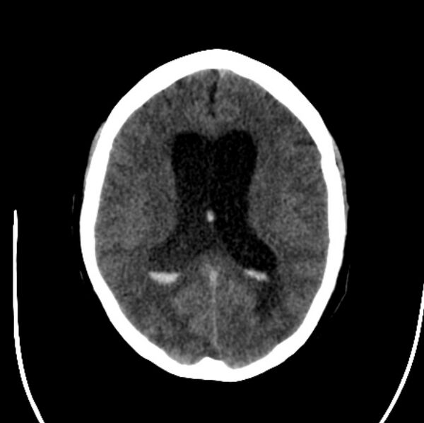 File:Cerebellar hemorrhage causing obstructive hydrocephalus (Radiopaedia 33989-35207 Axial non-contrast 30).jpg