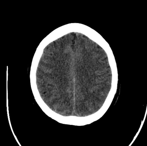 File:Cerebellar hemorrhage causing obstructive hydrocephalus (Radiopaedia 33989-35207 Axial non-contrast 38).jpg