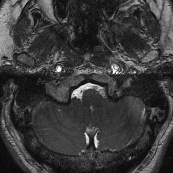 File:Cerebellopontine angle meningioma (Radiopaedia 24459-24764 I 6).jpg