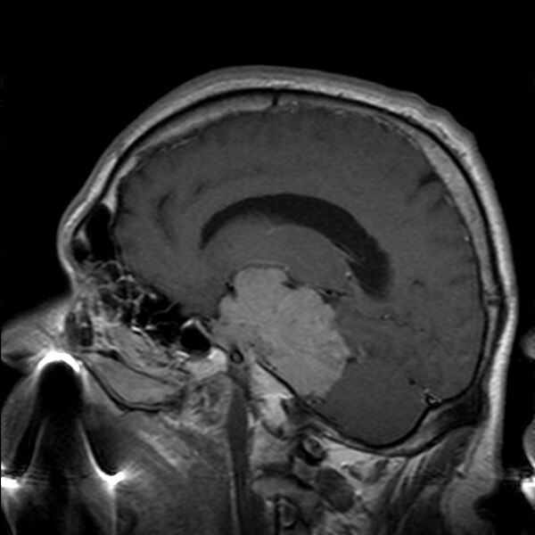 File:Cerebellopontine angle meningioma (Radiopaedia 24459-24764 Sagittal T1 C+ 10).jpg