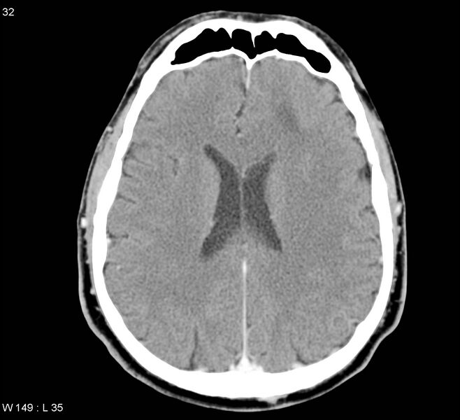 File:Cerebral abscess (Radiopaedia 5150-6933 Axial C+ delayed 1).jpg