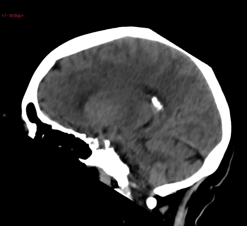 Cerebral amyloid angiopathy-associated lobar intracerebral hemorrhage (Radiopaedia 58378-65518 C 38).jpg