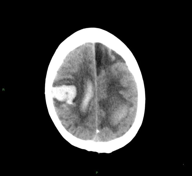 File:Cerebral amyloid angiopathy-associated lobar intracerebral hemorrhage (Radiopaedia 58529-65687 Axial non-contrast 14).jpg