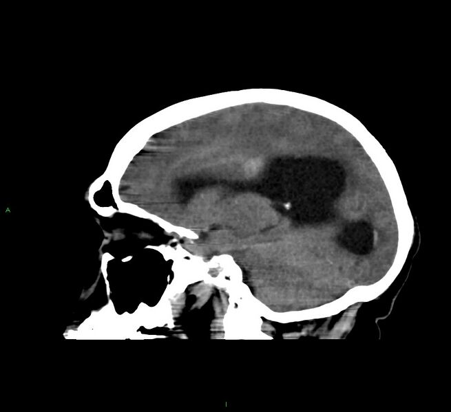 File:Cerebral amyloid angiopathy-associated lobar intracerebral hemorrhage (Radiopaedia 58560-65723 C 32).jpg