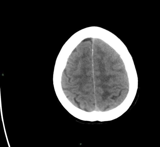 File:Cerebral amyloid angiopathy-associated lobar intracerebral hemorrhage (Radiopaedia 58561-65724 Axial non-contrast 8).jpg