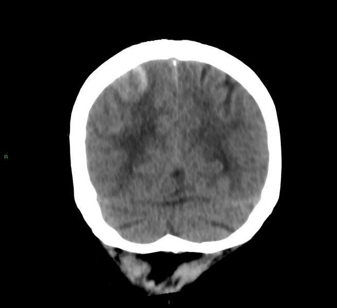 File:Cerebral amyloid angiopathy-associated lobar intracerebral hemorrhage (Radiopaedia 58566-65730 Coronal non-contrast 20).jpg