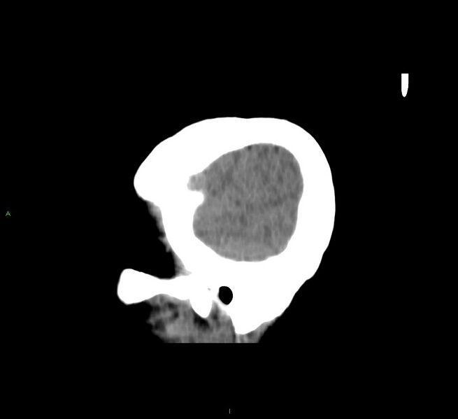 File:Cerebral amyloid angiopathy-associated lobar intracerebral hemorrhage (Radiopaedia 58751-65972 C 47).jpg