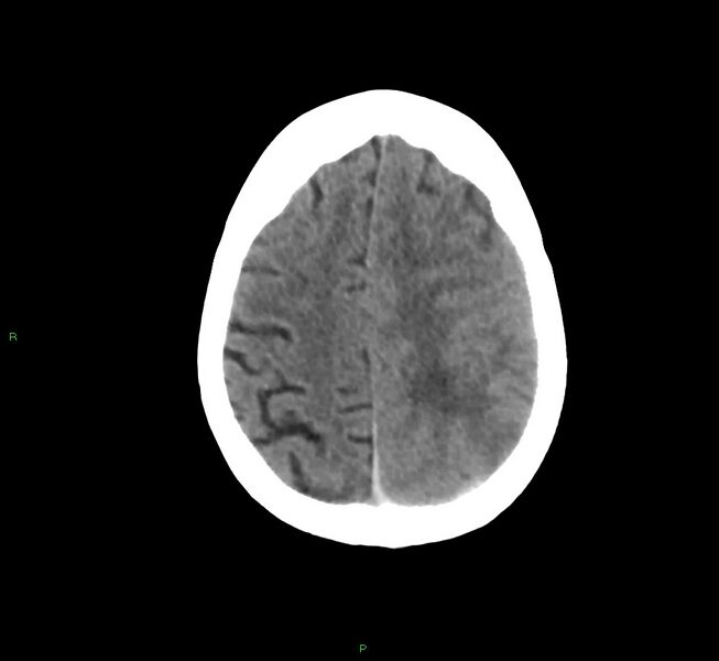 File:Cerebral amyloid angiopathy-associated lobar intracerebral hemorrhage (Radiopaedia 58754-65975 Axial non-contrast 21).jpg