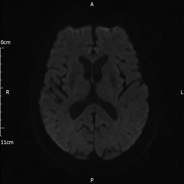 File:Cerebral amyloid angiopathy related inflammation (Radiopaedia 72772-83415 Axial DWI 59).jpg