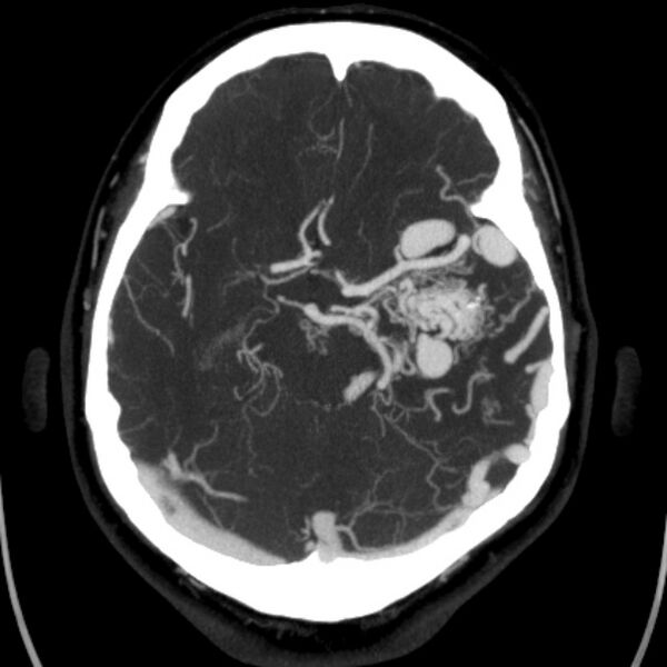 File:Cerebral arteriovenous malformation (Radiopaedia 43729-47189 B 20).jpg
