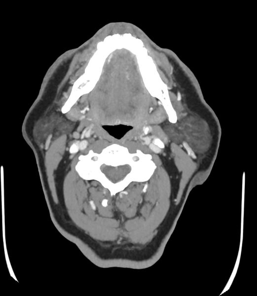 File:Cerebral dural venous sinus thrombosis (Radiopaedia 86514-102576 A 1).jpg