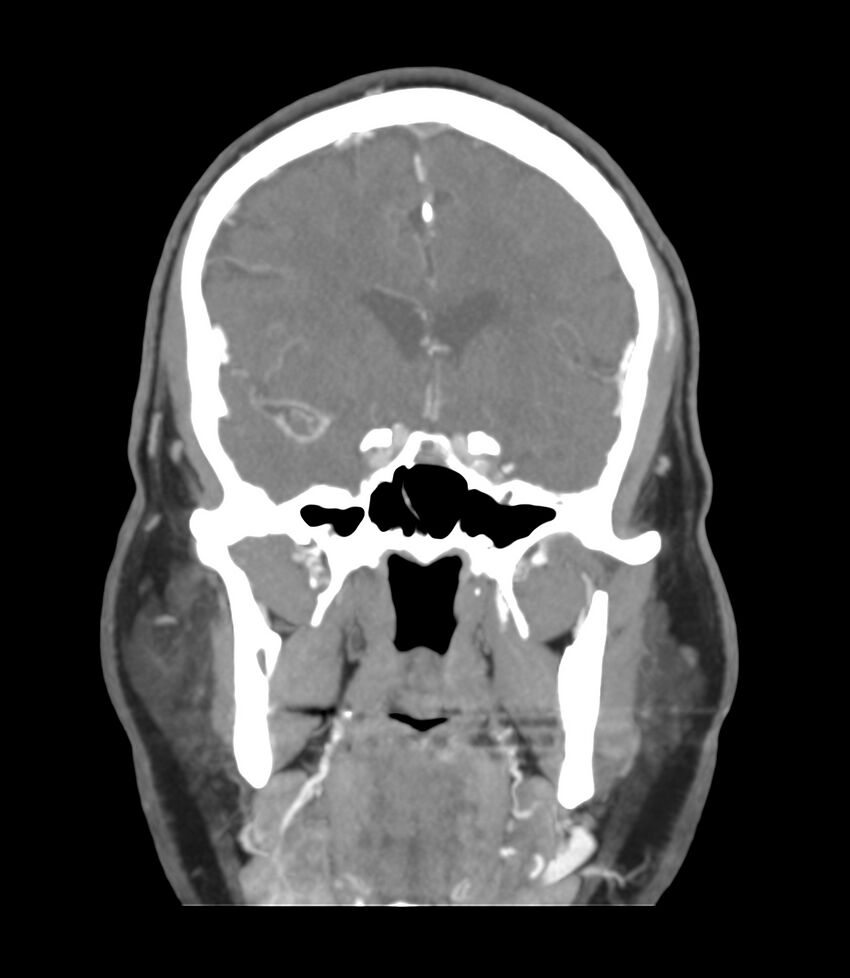 Cerebral dural venous sinus thrombosis (Radiopaedia 86514-102576 B 23).jpg