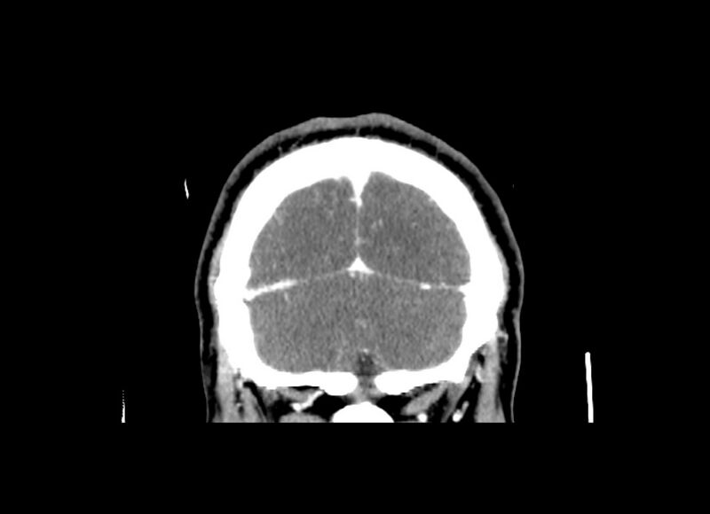 File:Cerebral edema (Radiopaedia 82519-96661 C 13).jpg