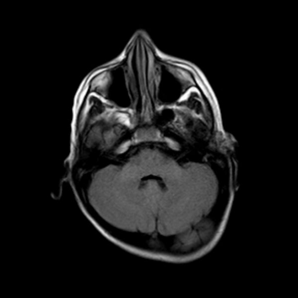 File:Cerebral tuberculoma (Radiopaedia 41152-43932 Axial FLAIR 5).jpg