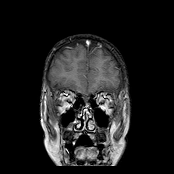 File:Cerebral tuberculoma (Radiopaedia 41152-43932 Coronal T1 C+ 2).jpg