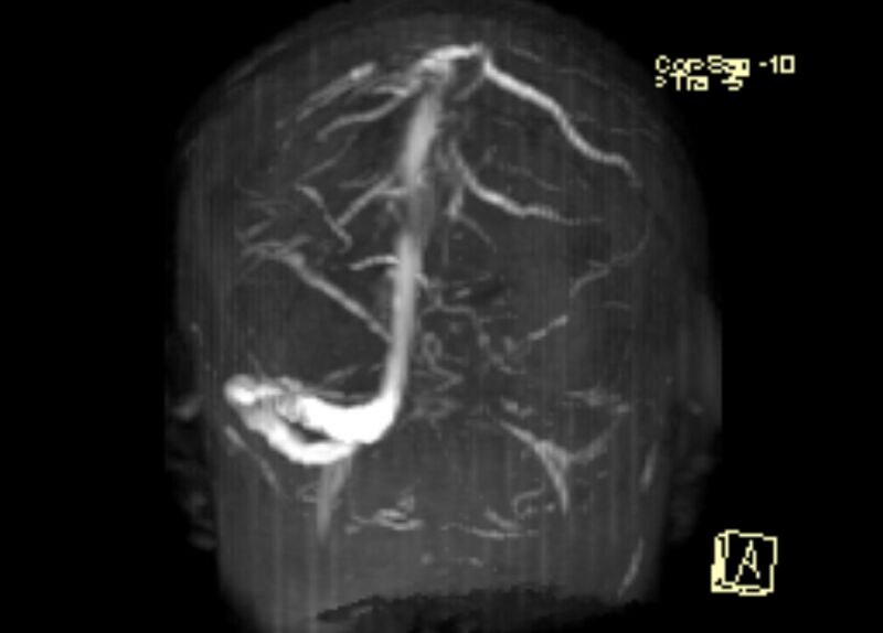 File:Cerebral venous infarct (Radiopaedia 53627-59723 3D MRV 10).jpg