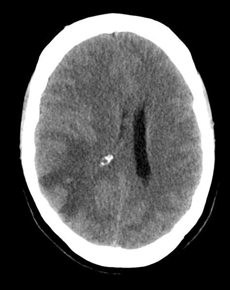 File:Cerebral venous infarct related to dural venous sinus thromboses (Radiopaedia 35292-36803 AXIAL THICK 17).png