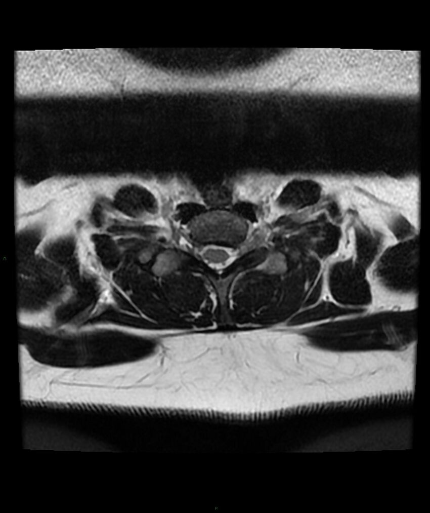 Cervical disc prolapse (Radiopaedia 80258-93598 Axial T2 71).jpg