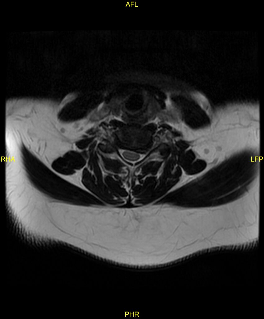 Cervical disc protrusion (Radiopaedia 87147-103415 Axial T2 37).jpg