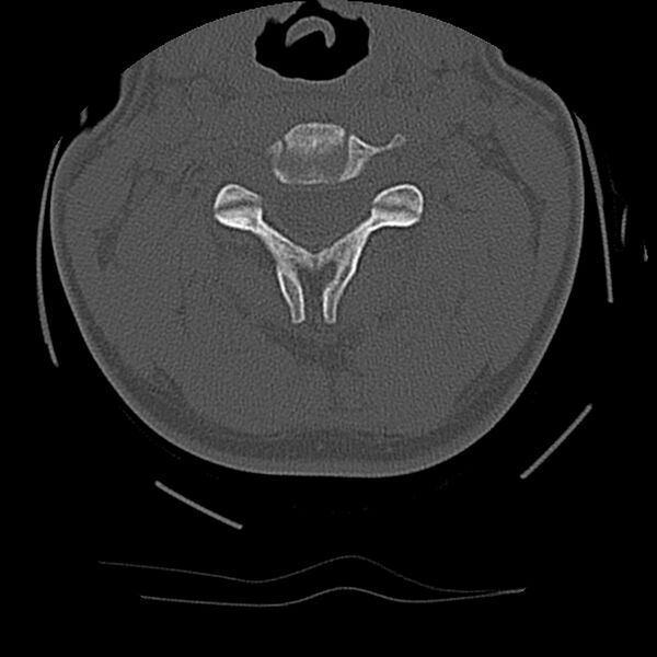 File:Cervical flexion teardrop fracture with cord hemorrhage (Radiopaedia 32497-33454 Axial bone window 30).jpg
